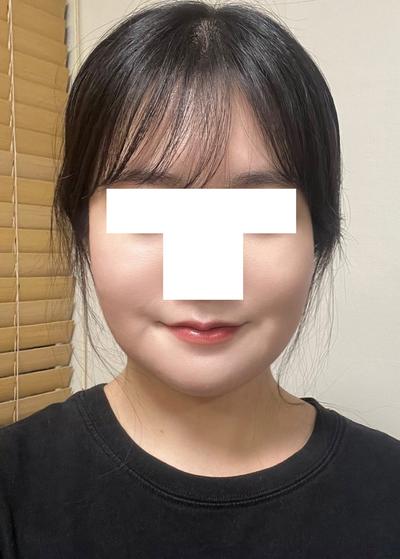 아큐스컬프 지방흡입 3주차, 이중턱살 거의 안 만져져요 — 아바성형외과 환자 후기 사진