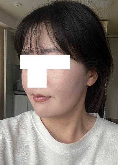 아큐스컬프 지방흡입 3주차, 이중턱살 거의 안 만져져요 사진 3 — 아바성형외과 이중턱·윤곽 후기