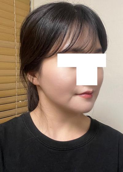 아큐스컬프 지방흡입 3주차, 이중턱살 거의 안 만져져요 사진 5 — 아바성형외과 이중턱·윤곽 후기