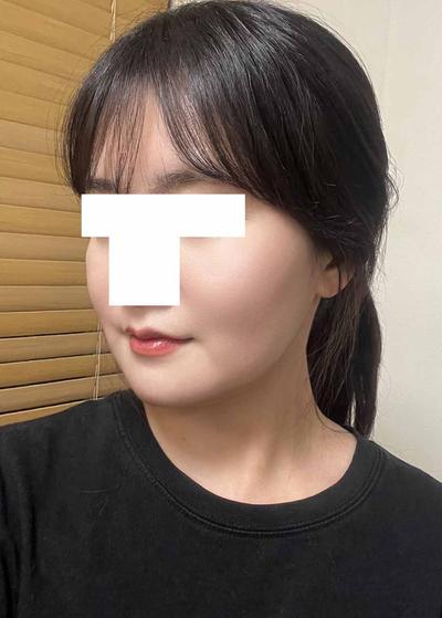 아큐스컬프 지방흡입 3주차, 이중턱살 거의 안 만져져요 사진 6 — 아바성형외과 이중턱·윤곽 후기