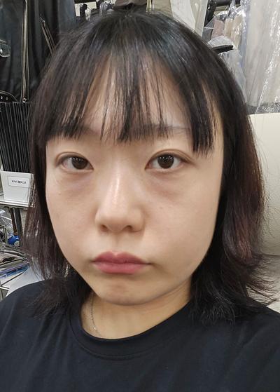 눈밑지방 수술 후기, 흉터 없이 다크써클 해결했어요 사진 3 — 아바성형외과 눈밑지방재배치 후기