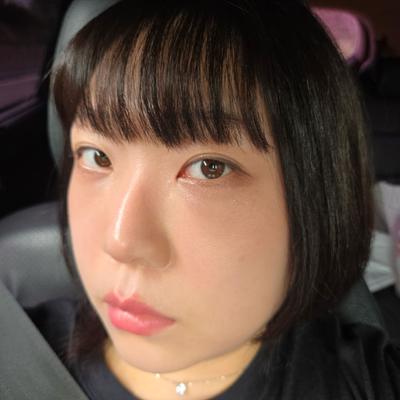 눈밑지방 수술 후기, 흉터 없이 다크써클 해결했어요 사진 4 — 아바성형외과 눈밑지방재배치 후기