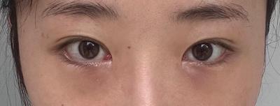 눈밑지방재배치 5주차, 피곤해 보이던 눈밑 진짜 매끈해요 사진 2 — 아바성형외과 눈밑지방재배치 후기