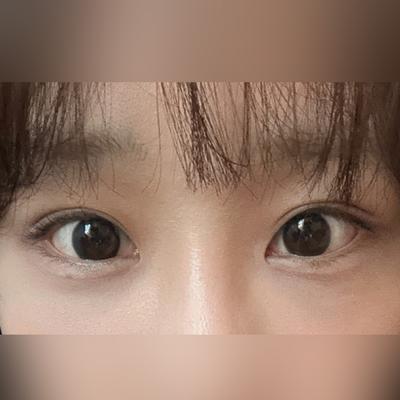 눈성형 환자 후기 — 브라운성형외과에서 김승수 원... (103)