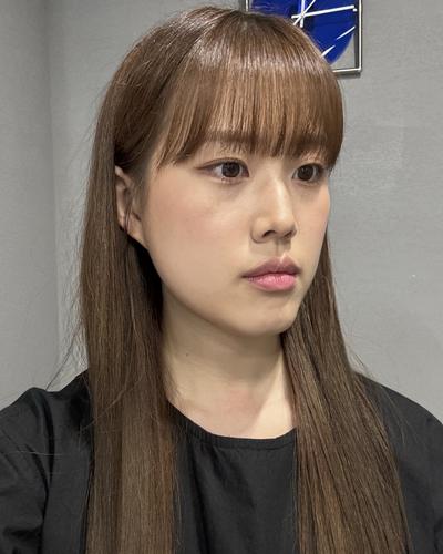 눈밑지방재배치 2주차, 눈밑 환해져서 고민한 게 후회돼요 사진 2 — 아바성형외과 눈밑지방재배치 후기