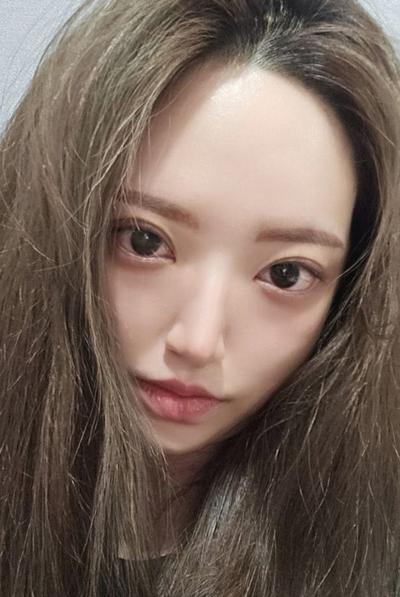 눈밑지방재배치 6주차, 어려보인다는 말 많이 들어요 사진 3 — 아바성형외과 눈밑지방재배치 후기