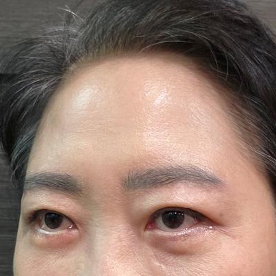 눈썹거상 6주차, 처짐 해결되고 눈썹 모양도 예뻐졌어요 사진 4 — 아바성형외과 안면거상 후기
