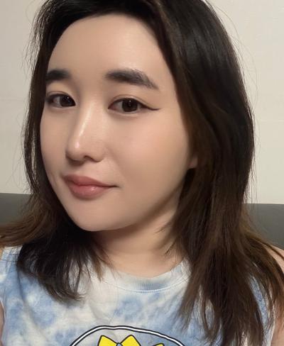 이마 볼륨 수술 수면마취로 끝, 티 안 나게 자연스러워요 — 아바성형외과 환자 후기 사진