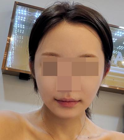 안면거상 환자 후기 — 브라운 성형외과에서 거상/아... (111)