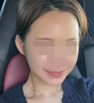 거상 아큐 7주차, 무턱까지 개선돼서 만족해요 사진 4 — 아바성형외과 안면거상 후기