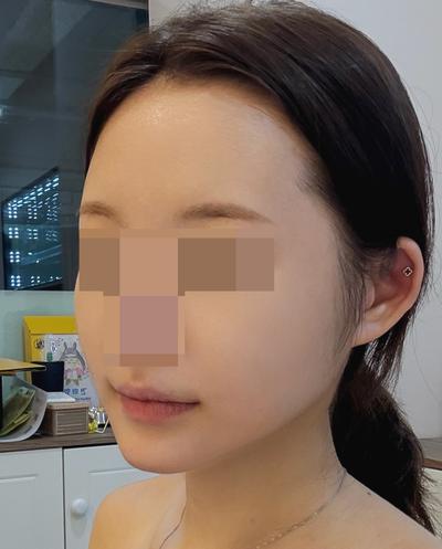 거상 아큐 7주차, 무턱까지 개선돼서 만족해요 사진 5 — 아바성형외과 안면거상 후기