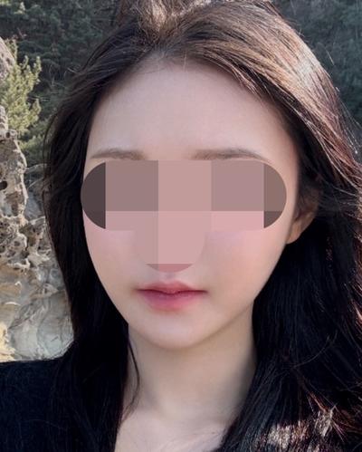 아큐스컬프 9주차, 볼살 턱살 정리되고 인상이 날렵해졌어요 — 아바성형외과 환자 후기 사진