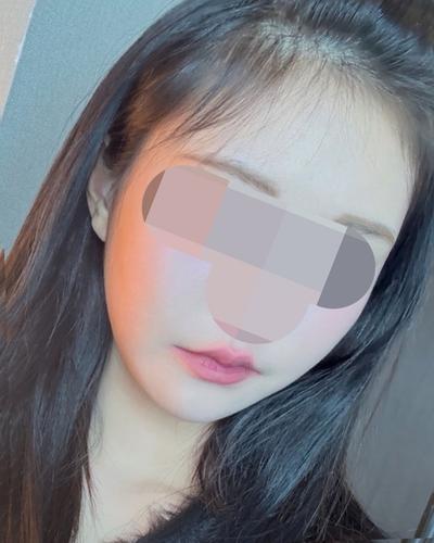 아큐스컬프 9주차, 볼살 턱살 정리되고 인상이 날렵해졌어요 사진 5 — 아바성형외과 이중턱·윤곽 후기