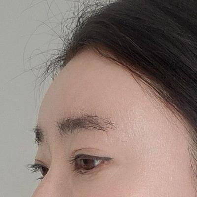 이마거상 4주차, 주변에서 젊어졌다는 소리 들어 뿌듯해요 — 아바성형외과 환자 후기 사진