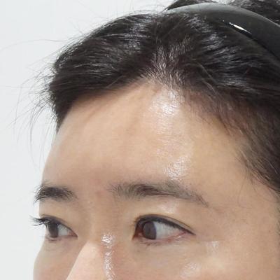 이마거상 4주차, 주변에서 젊어졌다는 소리 들어 뿌듯해요 사진 2 — 아바성형외과 안면거상 후기