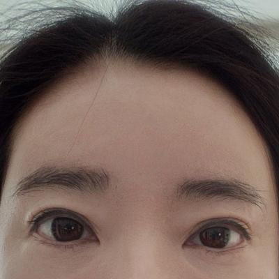 이마거상 4주차, 주변에서 젊어졌다는 소리 들어 뿌듯해요 사진 4 — 아바성형외과 안면거상 후기