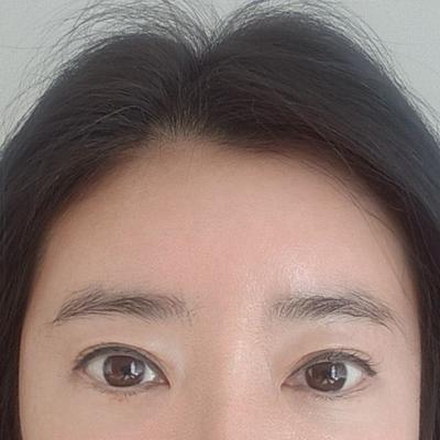 눈 비대칭 수술 후기, 몰랐던 단점 고치고 지금은 대만족이에요 — 아바성형외과 환자 후기 사진