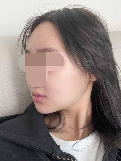아큐 7주차, 큰 붓기 다 빠지고 턱밑만 조금 남았어요 — 아바성형외과 환자 후기 사진