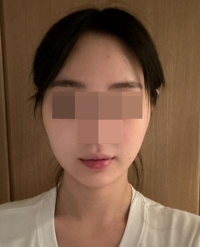 아큐 7주차, 큰 붓기 다 빠지고 턱밑만 조금 남았어요 사진 3 — 아바성형외과 기타 후기