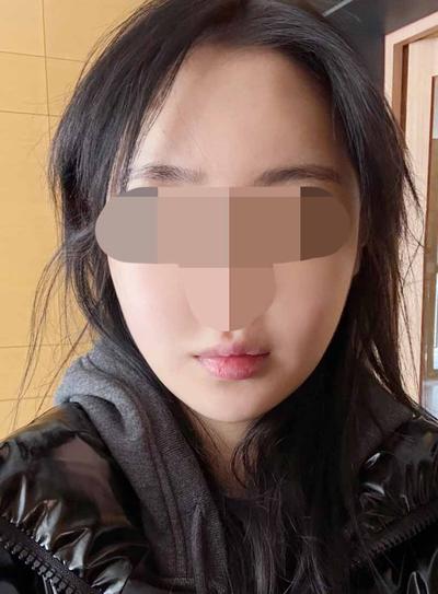 아큐 7주차, 큰 붓기 다 빠지고 턱밑만 조금 남았어요 사진 4 — 아바성형외과 기타 후기