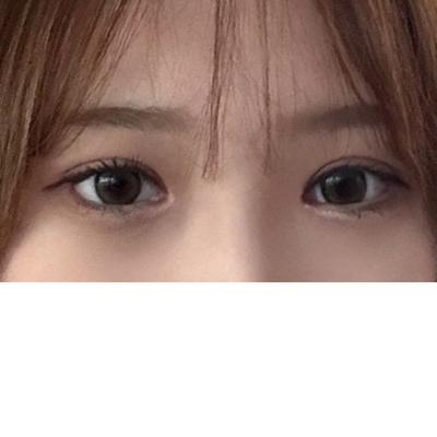 쌍꺼풀 재수술 6주차, 소시지 라인이랑 꼬막눈 다 없어졌어요 — 아바성형외과 환자 후기 사진