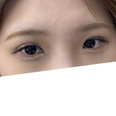 쌍꺼풀 재수술 6주차, 소시지 라인이랑 꼬막눈 다 없어졌어요 사진 2 — 아바성형외과 쌍꺼풀·눈성형 후기