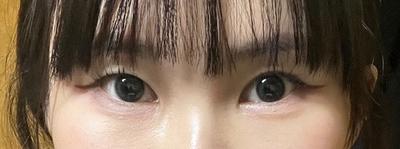 절개 쌍꺼풀 재수술 3개월차, 비대칭도 라인도 잘 잡혔어요 사진 2 — 아바성형외과 쌍꺼풀·눈성형 후기
