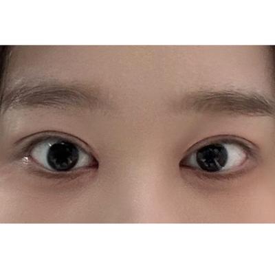 눈성형 환자 후기 — 브라운성형외과 김승수 원장님... (12)