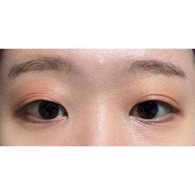 절개 쌍꺼풀 눈매교정 앞트임 6주차, 눈이 더 커보여요 사진 2 — 아바성형외과 쌍꺼풀·눈성형 후기