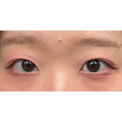 절개 쌍꺼풀 눈매교정 앞트임 6주차, 눈이 더 커보여요 사진 3 — 아바성형외과 쌍꺼풀·눈성형 후기