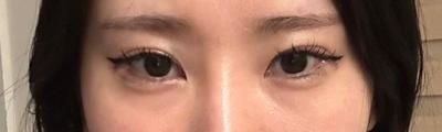눈밑지방 수술 5주차, 자연스럽게 어려보여서 완전 만족 사진 2 — 아바성형외과 눈밑지방재배치 후기