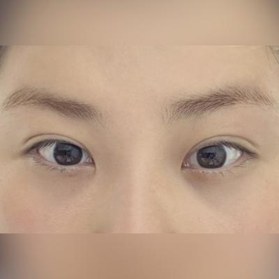 중안면거상+눈밑지방재배치 6주차, 인상 밝아졌다는 말 많이 들어요 — 아바성형외과 환자 후기 사진