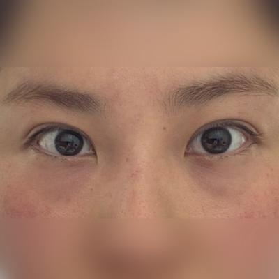 중안면거상+눈밑지방재배치 6주차, 인상 밝아졌다는 말 많이 들어요 사진 2 — 아바성형외과 눈밑지방재배치 후기