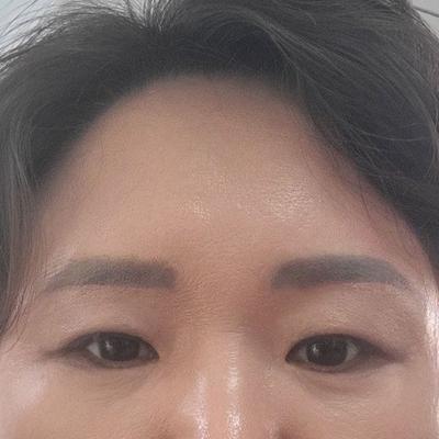 안면거상 환자 후기 — 시술8주차 사진입니다.
시술... (126)