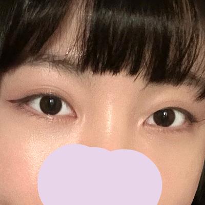 눈밑지방재배치 2주차, 애굣살은 살고 지방은 사라져 행복해요 — 아바성형외과 환자 후기 사진