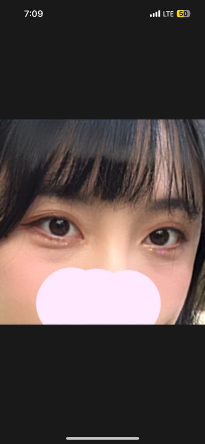 눈밑지방재배치 2주차, 애굣살은 살고 지방은 사라져 행복해요 사진 2 — 아바성형외과 눈밑지방재배치 후기