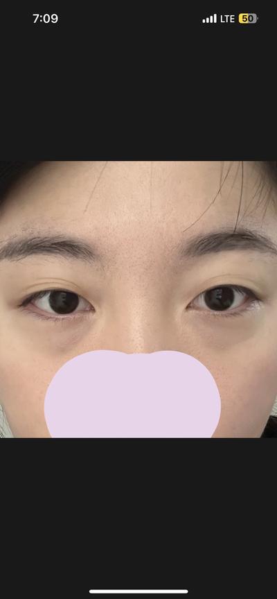 눈밑지방재배치 2주차, 애굣살은 살고 지방은 사라져 행복해요 사진 3 — 아바성형외과 눈밑지방재배치 후기