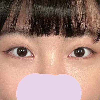 눈밑지방재배치 2주차, 애굣살은 살고 지방은 사라져 행복해요 사진 4 — 아바성형외과 눈밑지방재배치 후기