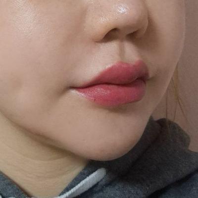 쁘띠시술 환자 후기 — 웃을 때 입 주변이 퍼져 보... (13)