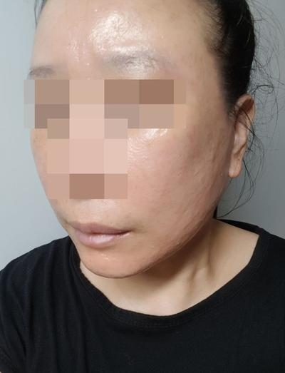 안면거상 윤곽3종 5주차, 이번주부터 붓기 팍팍 빠져요 — 아바성형외과 환자 후기 사진
