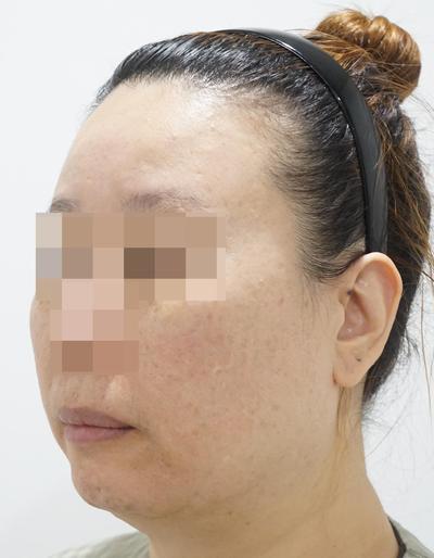 안면거상 윤곽3종 5주차, 이번주부터 붓기 팍팍 빠져요 사진 2 — 아바성형외과 안면거상 후기