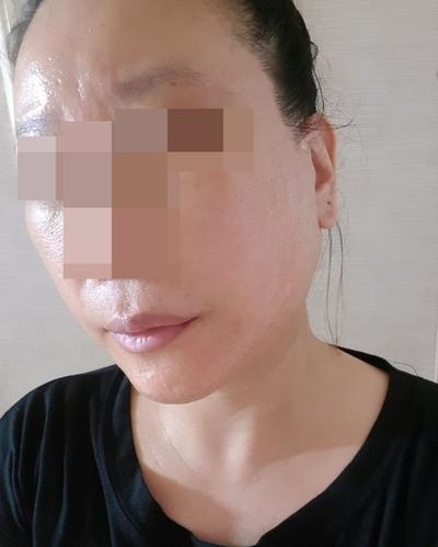 안면거상 윤곽3종 5주차, 이번주부터 붓기 팍팍 빠져요 사진 3 — 아바성형외과 안면거상 후기
