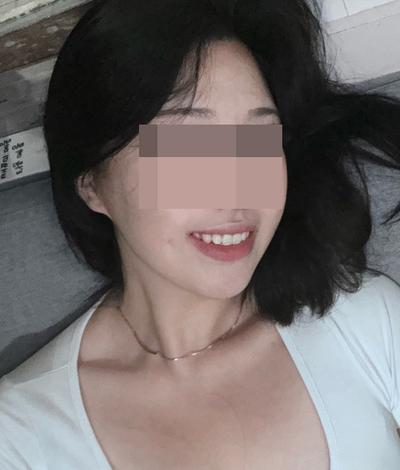 아큐스컬프 6개월차, 살 빼도 없던 턱선이 사진에도 보여요 — 아바성형외과 환자 후기 사진