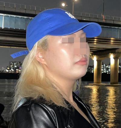 아큐스컬프 6개월차, 살 빼도 없던 턱선이 사진에도 보여요 사진 2 — 아바성형외과 지방이식 후기