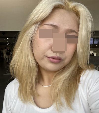 아큐스컬프 6개월차, 살 빼도 없던 턱선이 사진에도 보여요 사진 3 — 아바성형외과 지방이식 후기