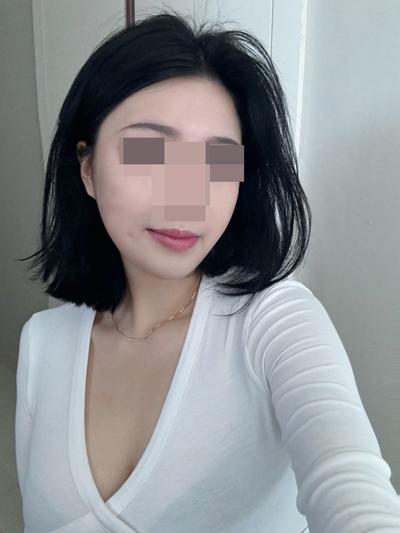 아큐스컬프 6개월차, 살 빼도 없던 턱선이 사진에도 보여요 사진 4 — 아바성형외과 지방이식 후기