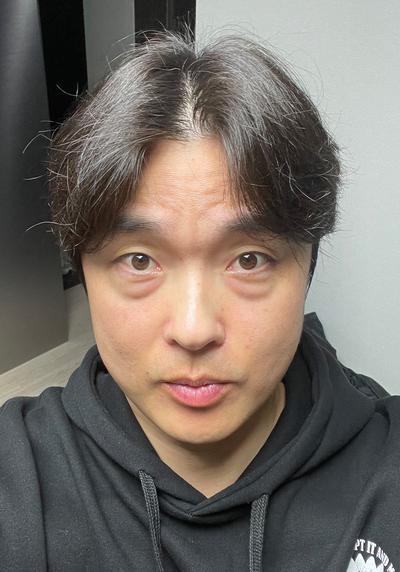 수술 5주차, 붓기 다 빠지고 주변에서 못 알아볼 정도예요 사진 2 — 아바성형외과 기타 후기