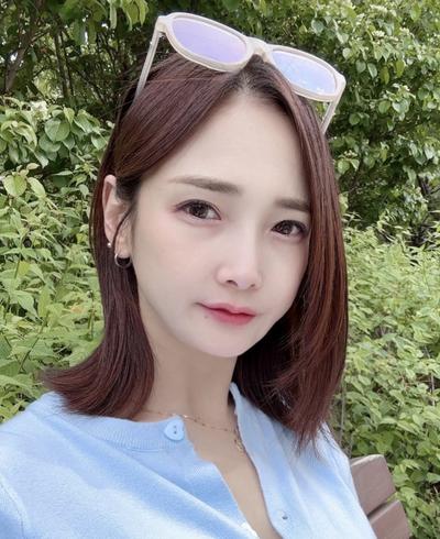 눈밑지방재배치 하안검 4주차, 꺼진 눈밑 잔주름 채웠어요 사진 2 — 아바성형외과 눈밑지방재배치 후기