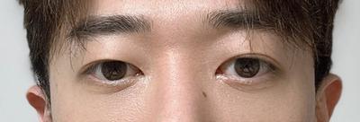 눈밑지방재배치 후기, 붓기 1～2주 빼곤 불편함도 없었어요 — 아바성형외과 환자 후기 사진