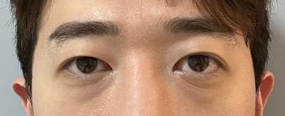 눈밑지방재배치 후기, 붓기 1～2주 빼곤 불편함도 없었어요 사진 2 — 아바성형외과 눈밑지방재배치 후기